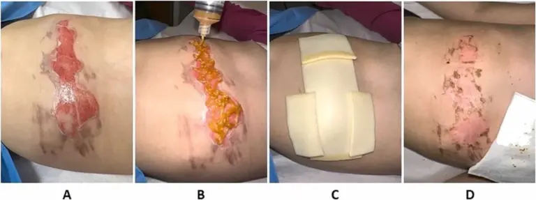 Med na spáleniny? Proč funguje lépe než drahé masti.