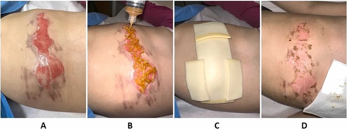 Med na spáleniny? Proč funguje lépe než drahé masti.